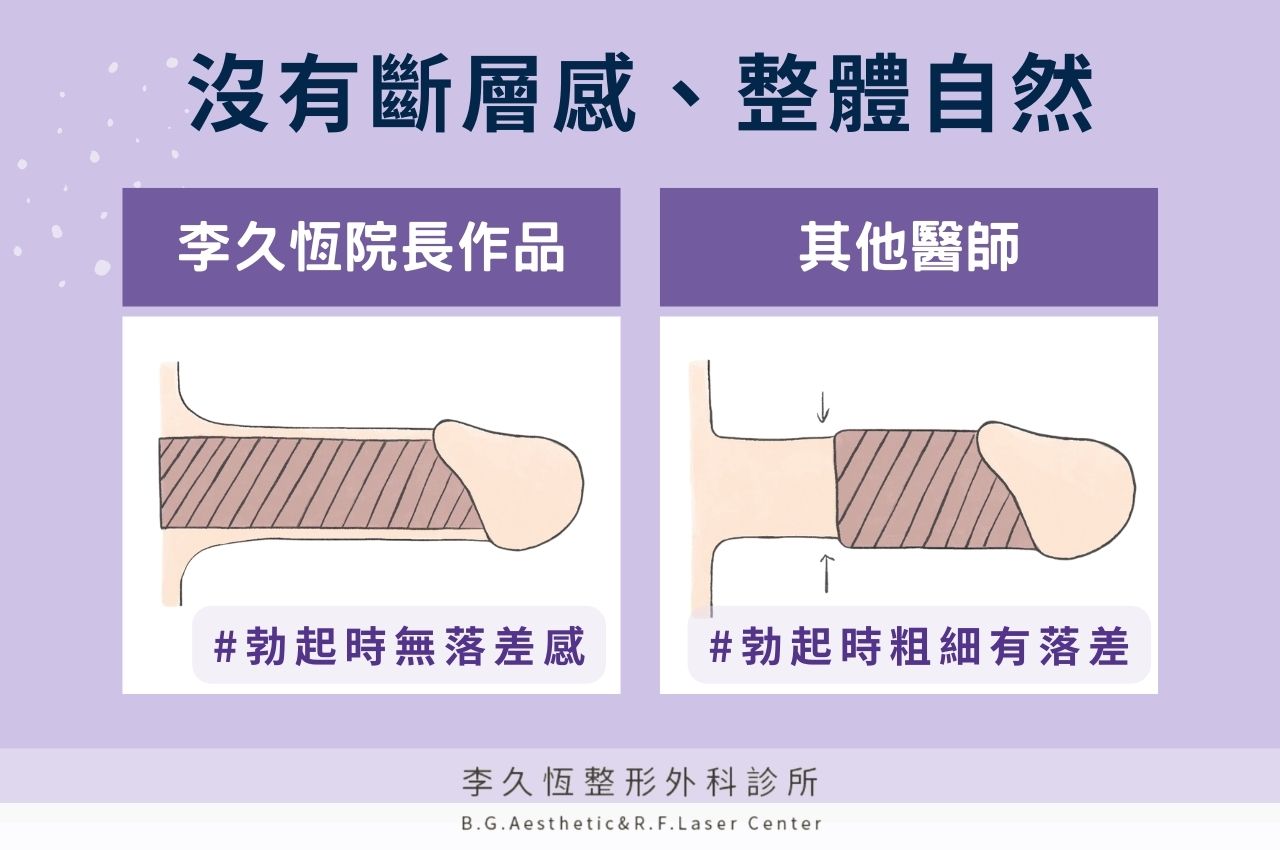 陰莖增粗手術優勢2