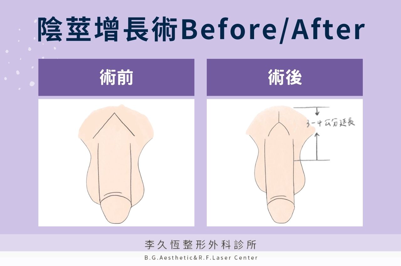 陰莖增長手術對比