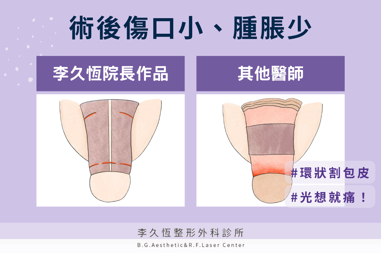 陰莖增粗手術優勢