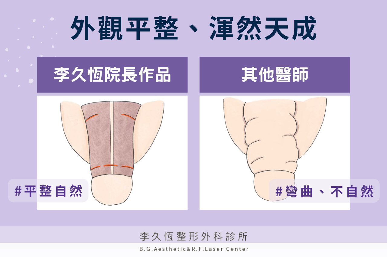 陰莖增粗手術優勢3
