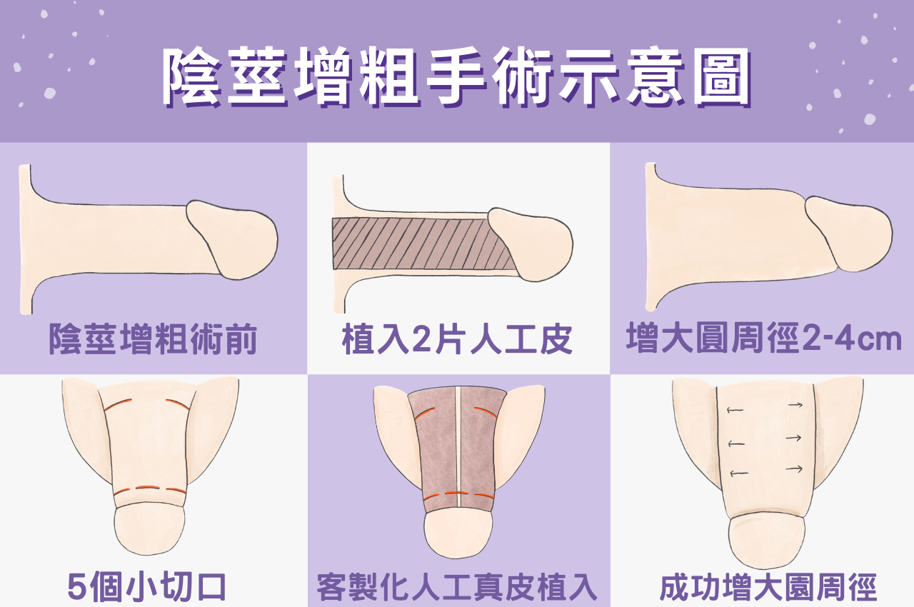 陰莖增粗手術過程
